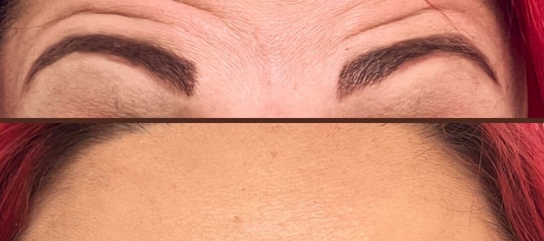 Before and after of a woman with anti-wrinkle treatment to forehead showing smooth skin in the after photo