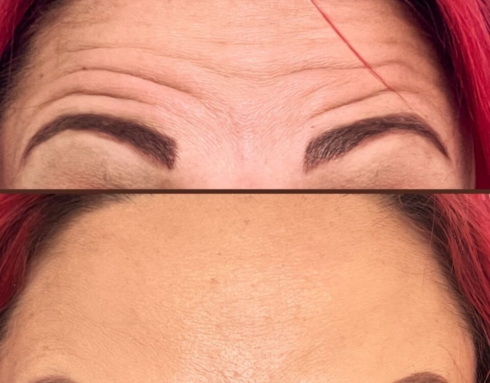 Before and after of a woman with anti-wrinkle treatment to forehead showing smooth skin in the after photo