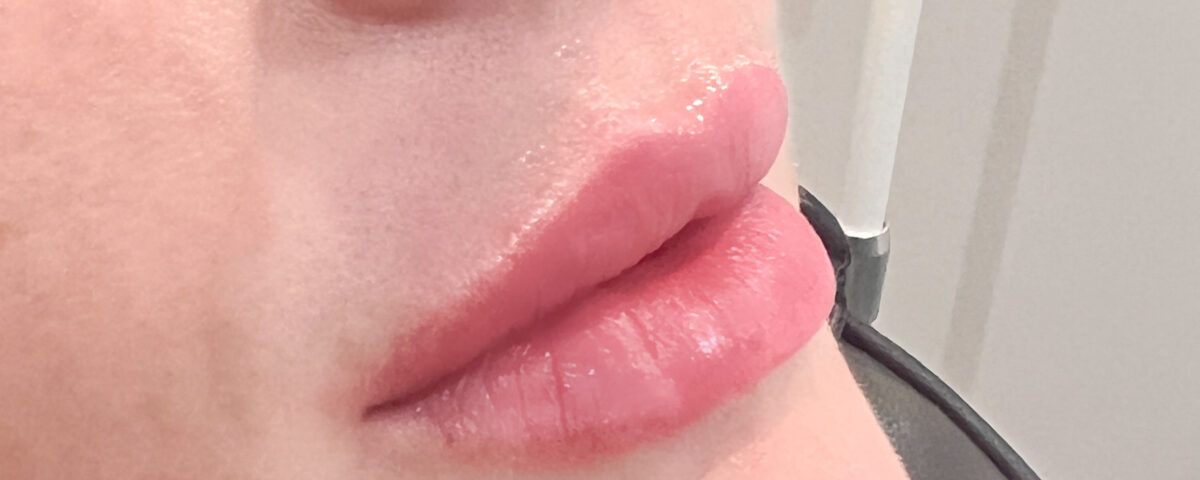Dermal filler used to create full lips on a woman