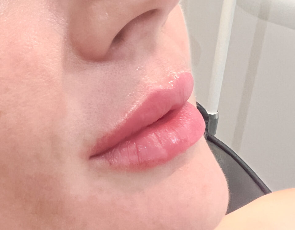 Dermal filler used to create full lips on a woman
